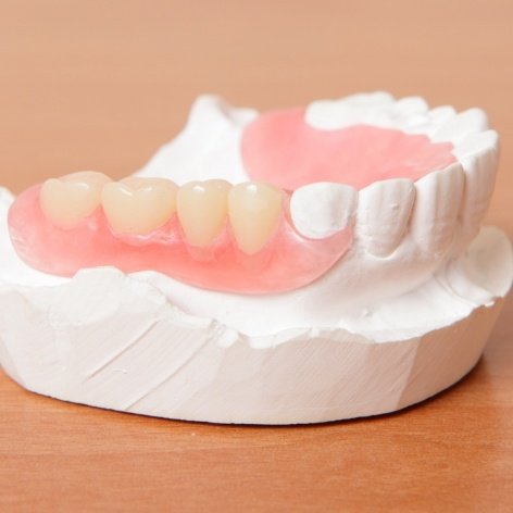 Partial denture on a smile model