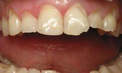 Smile with broken teeth before restorative dentistry