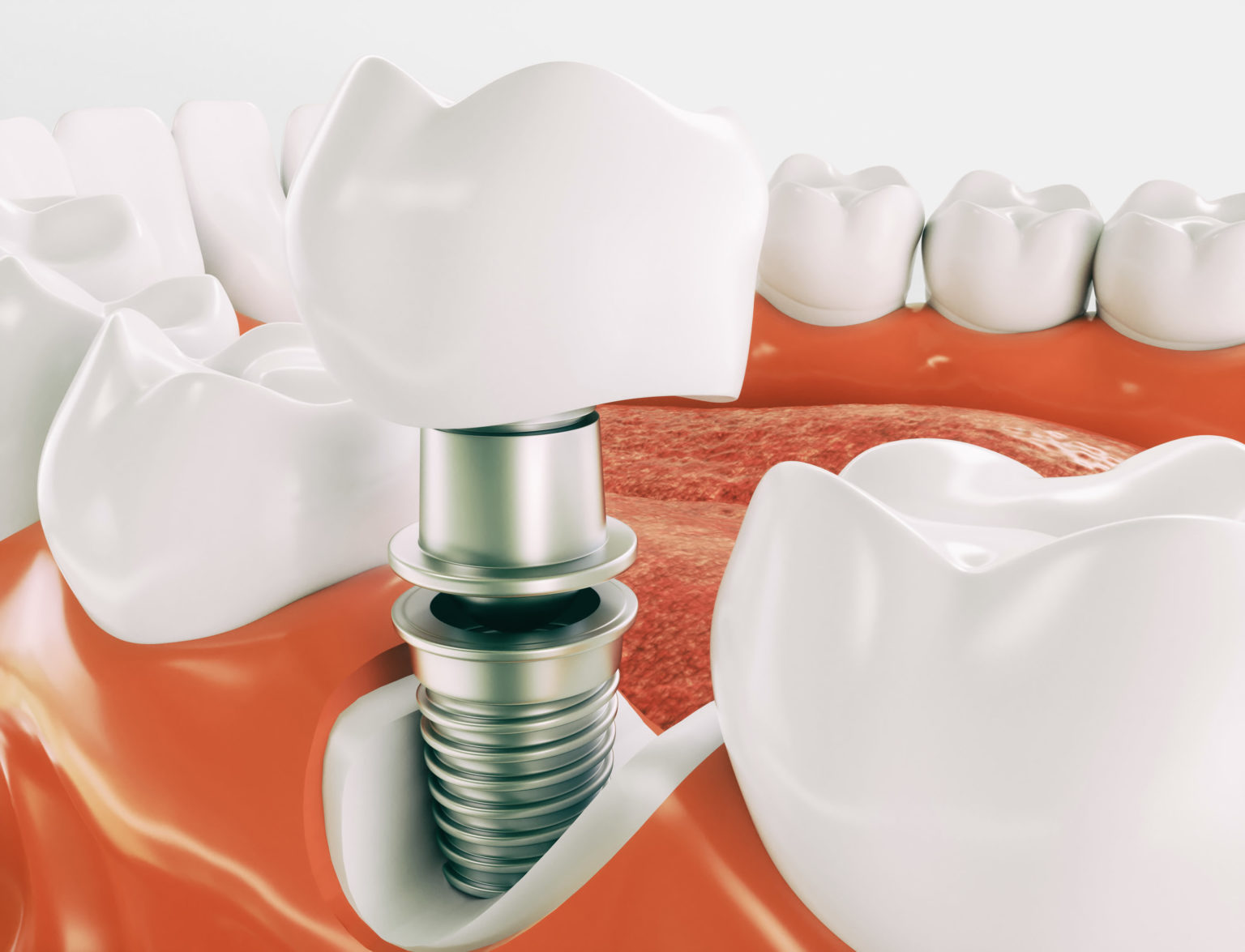 Need Dental Implants? How to Plan for Implant Treatment